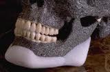 Medpor Jaw Angle Implants Dr Barry Eppley Indianapolis