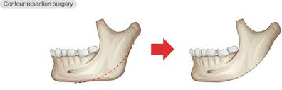 Jaw-Angle-Reduction-Surgery-Dr-Barry-Epp