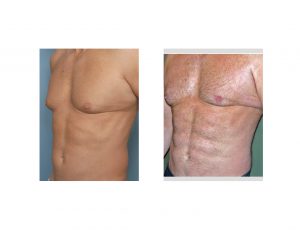 Abdominal Etching result oblique view Dr Barry Eppley Indianapolis