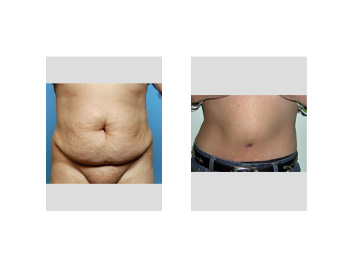 eppley abdominoplasty