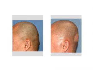 Custom Skull Implant and Occipital Knob Reduction results side view Dr Barry Eppley Indianapolis