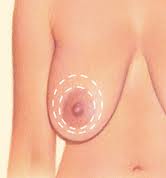 Donut Breast Lift Dr Barry Eppley Indianapolis