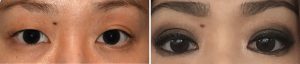 double-eyelid-surgery-results-dr-barry-eppley-indianapolis