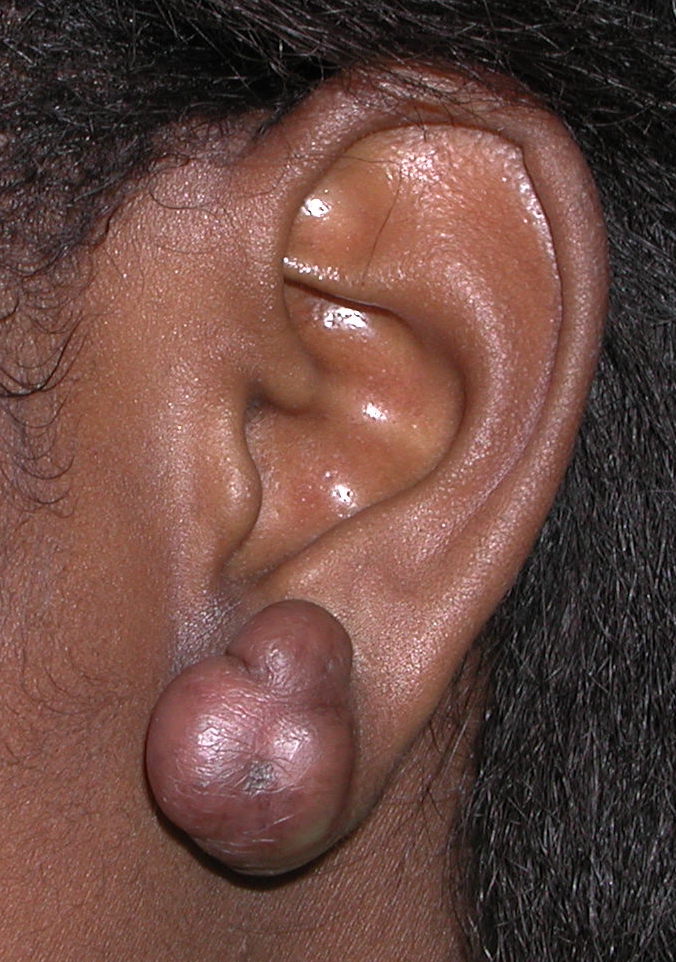 Split Earlobe Corrective Surgery By Ear Specialist Mark Sheldon Lloyd