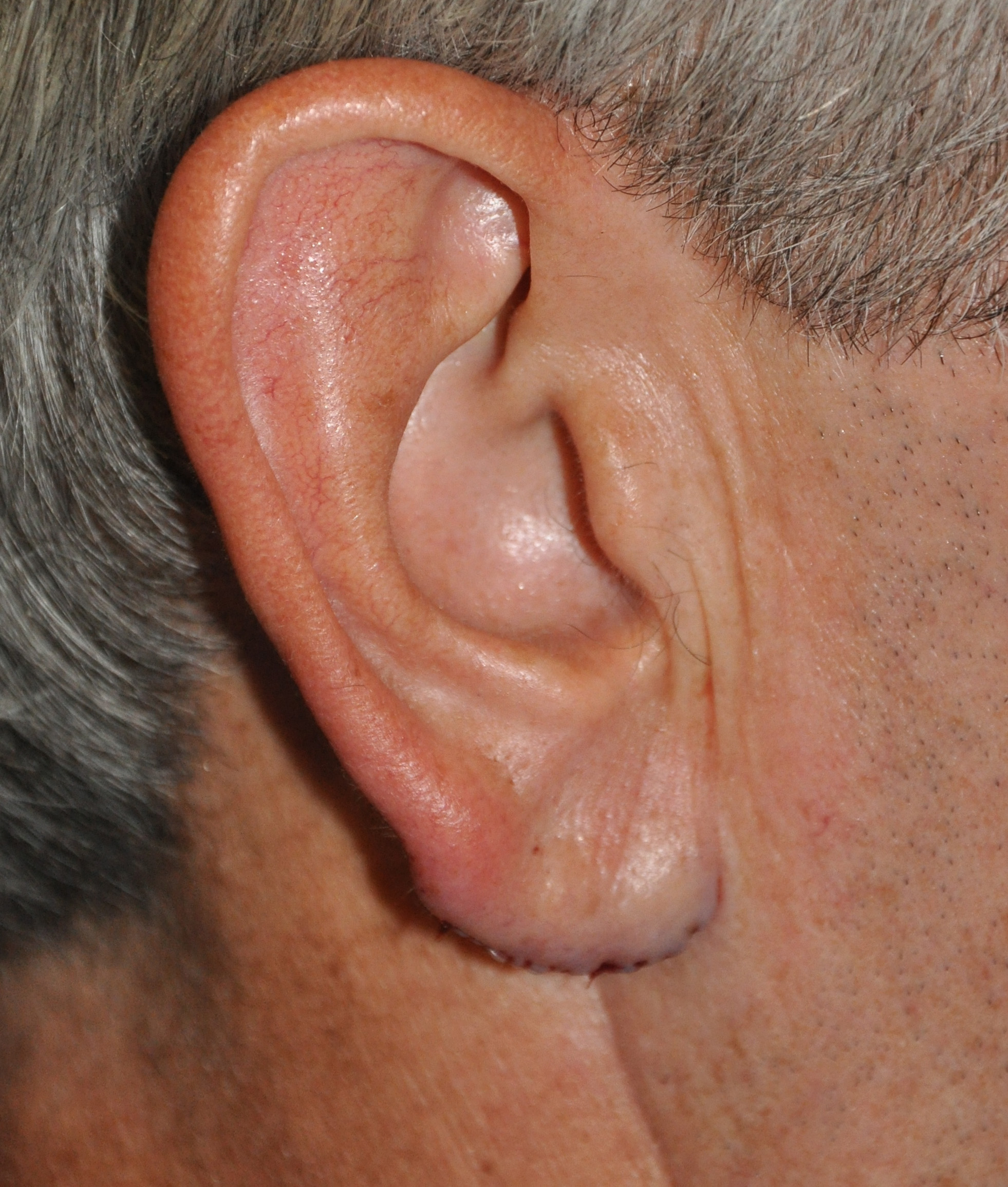 How to Reduce Large Ears and Earlobes - Visage Cosmetic Plastic Surgery