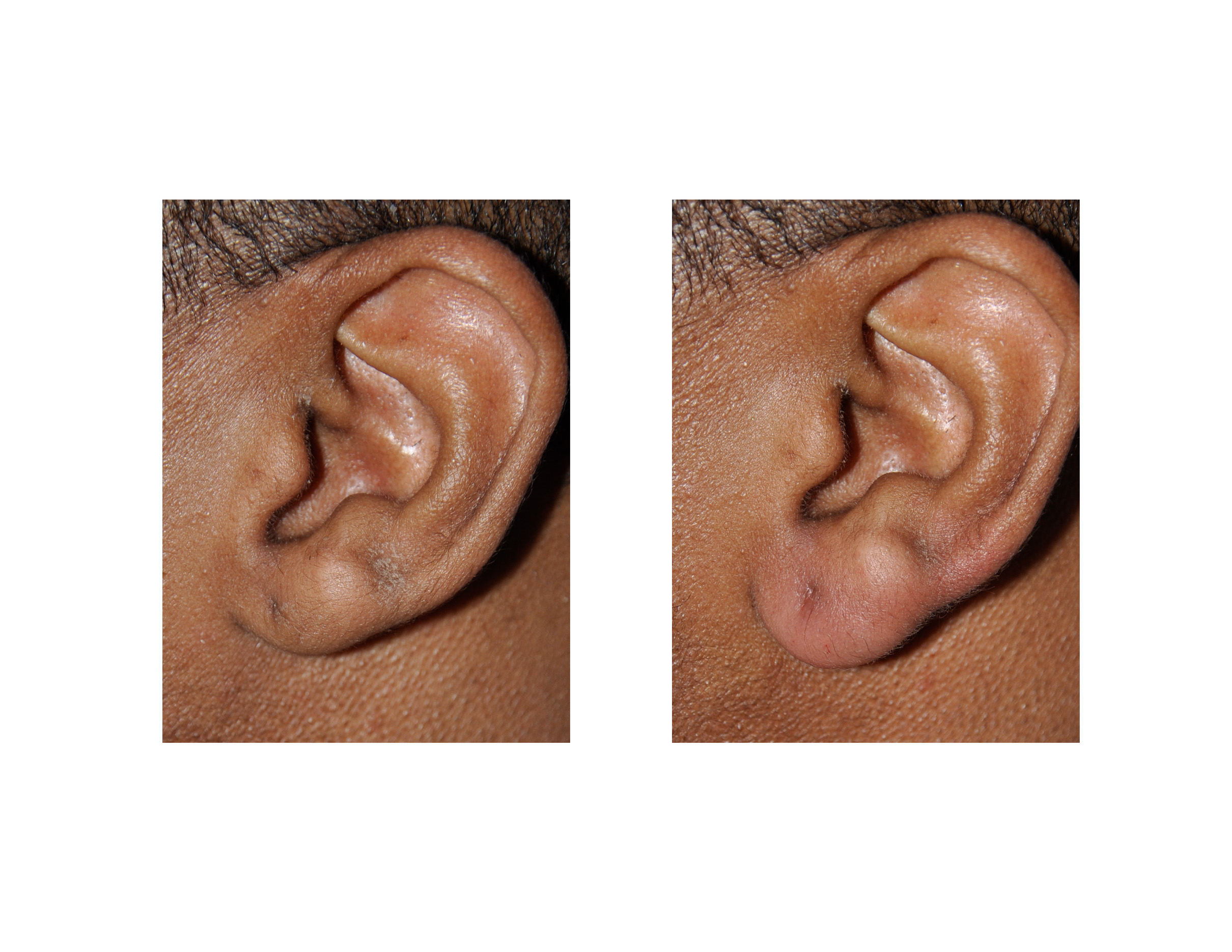 Earlobe Enlargement by Injectable Fillers Dr Barry Eppley Indianapolis