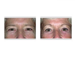 Endoscopic Browlift results Indianapolis Dr Barry Eppley