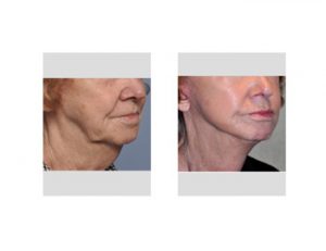 Facelift Dr Barry Eppley Indianapolis