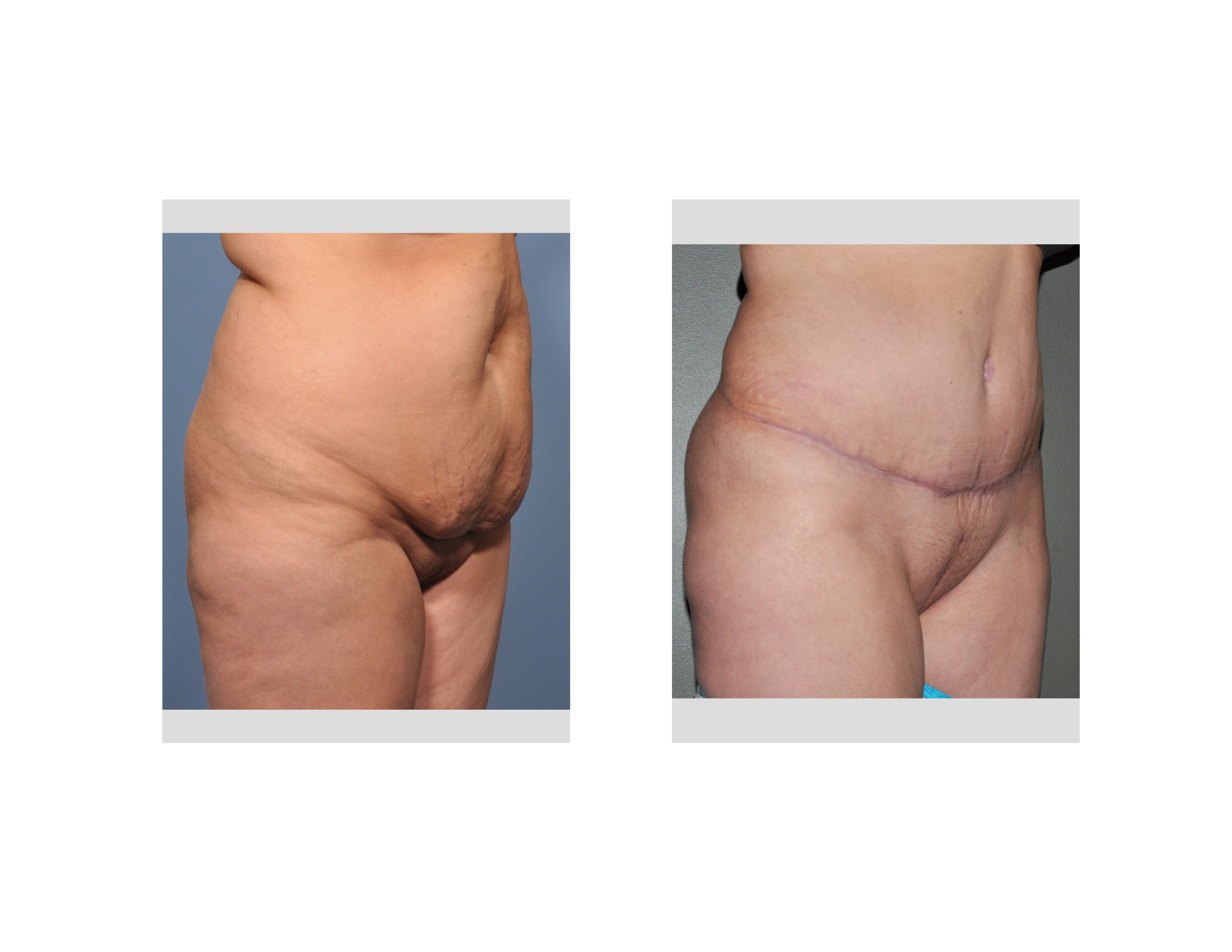 Full Tummy Tuck result right oblique view Dr Barry Eppley Indianapolis