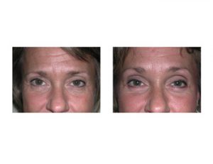Hairline Browlift Results Dr Barry Eppley Indianapolis