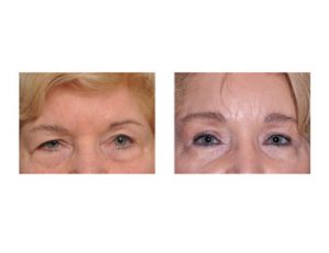Hairline Browlift with Upper Eyelid Lift results Dr Barry Eppley Indianapolis