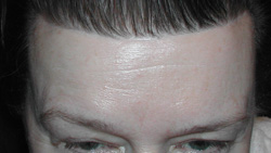 Hairline Pretrichial Browlift Scar Dr Barry Eppley Indianapolis