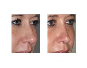 Hump Reduction Rhinoplasty result oblique view Dr Barry Eppley Indianapolis