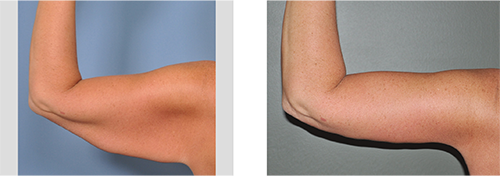 arm lift incision scar