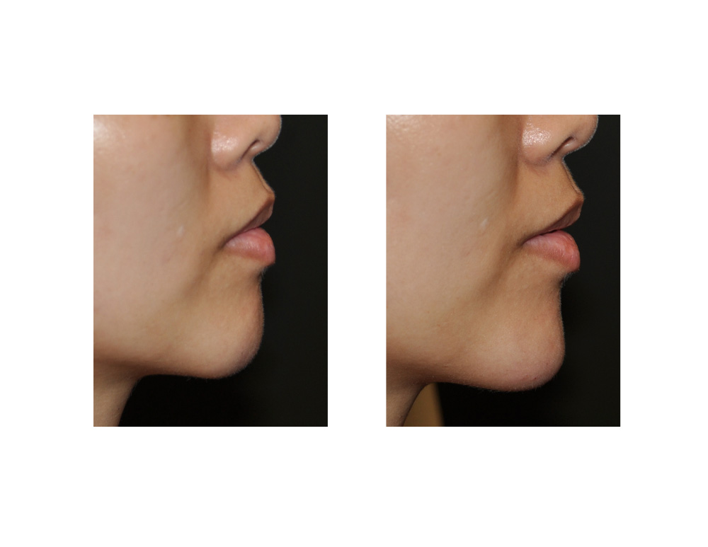 Injectable Chin Augmentation (Voluma) result side view Dr Barry Eppley Indianapolis