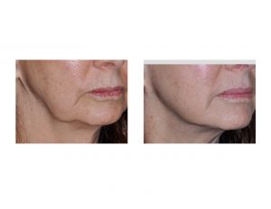 Kybella Injections for Jowls result right oblique view Dr Barry Eppley Indianapolis