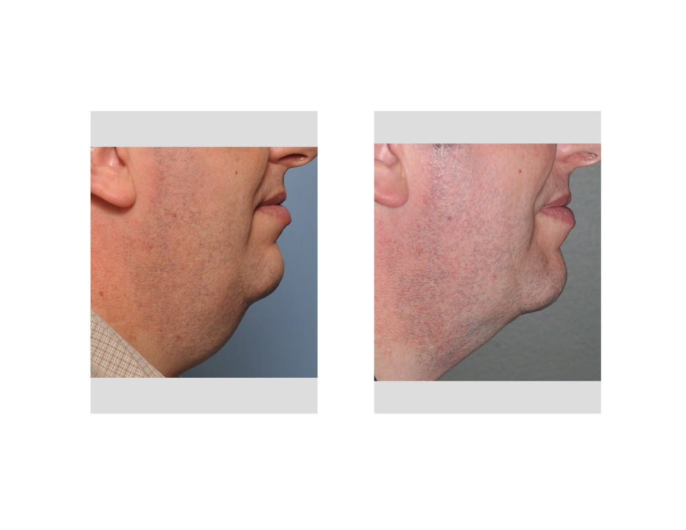 Large Neck Liposuction result side view