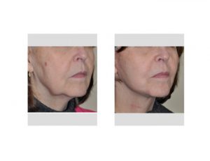 Limited Facelift (Jowl Lift) Dr Barry Eppley Indianapolis