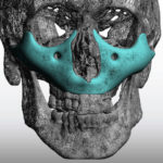 MIdface-Mask-Implant-design-3D-front-view-Dr-Barry-Eppley-Indianapolis