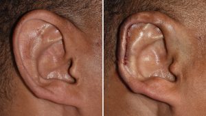 macrotia-right-ear-scaphal-reduction-intraop-result-dr-barry-eppley-indianapolis