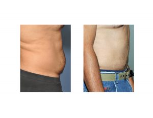 Male Abdominal Liposuction result side view Dr Barry Eppley Indianapolis
