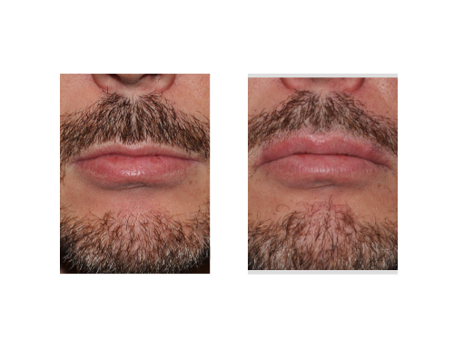 Male Lip Advancement result front view