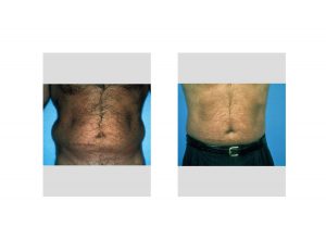 Male Wasitline Reshaping Liposuction result front view Dr Barry Eppley Indianapolis