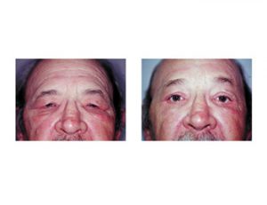 Mid-Forehead Lift result Dr Barry Eppley Indianapolis