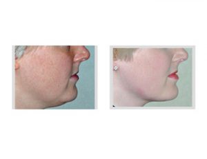 Neck Liposuction Dr Barry Eppley Indianapolis