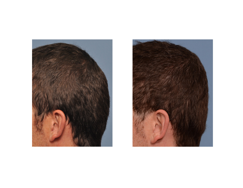 PMMA Bone Cement Occipital Augmentation results side view Dr Barry Eppley Indianapolis