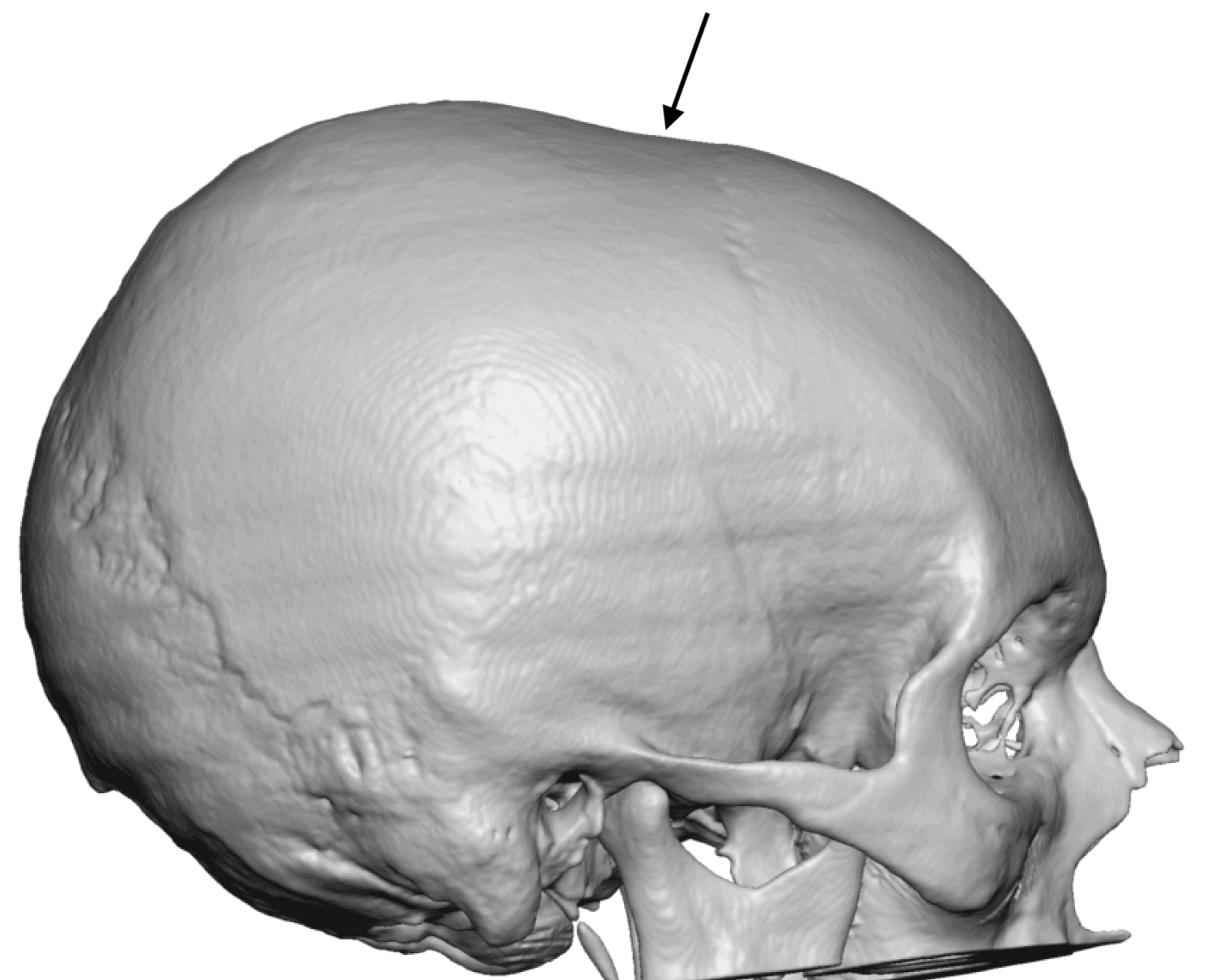 Skull Reshaping Plastic Surgeon Dr Barry L Eppley Md