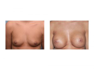 silicone-breast-augmentation-result-front-view-dr-barry-eppley-indianapolis