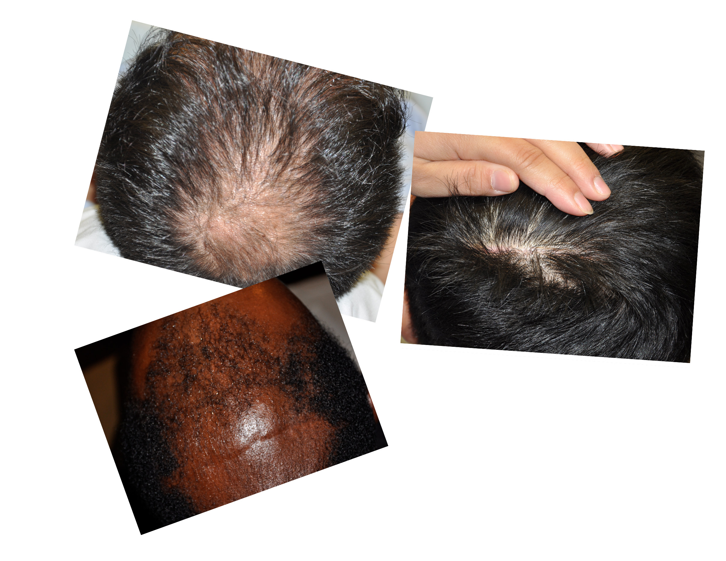 Skull Reshaping Scalp Scars Dr Barry Eppley Indianapolis