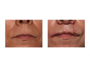 Subnasal Lip Lift with Lateral Vermilion Advancements result front view Dr Barry Eppley Indianapolis