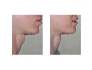 Tracheal Shave Dr Barry Eppley Indianapolis