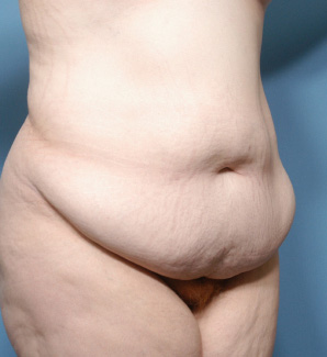 Tummy Tuck - Plastic Surgeon