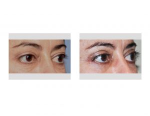 Upper Blepharoplasty result oblique view Dr Barry Eppley