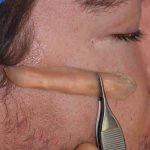 zygomatic-arch-implant-dr-barry-eppley-indianapolis
