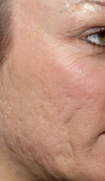 Acne Scars Dr Barry Eppley Indianapolis