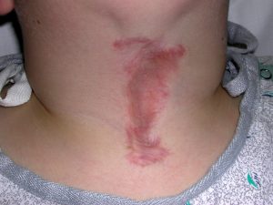 Atrophic Scar Dr Barry Eppley Indianapolis