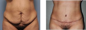 Hispanic Tummy Tuck result oblique view