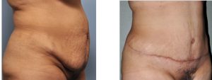 Hispanic Tummy Tuck result oblique view