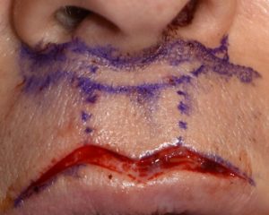 Techniques in Cupid's Bow Reshaping of the Upper Lip - Explore Plastic  Surgery