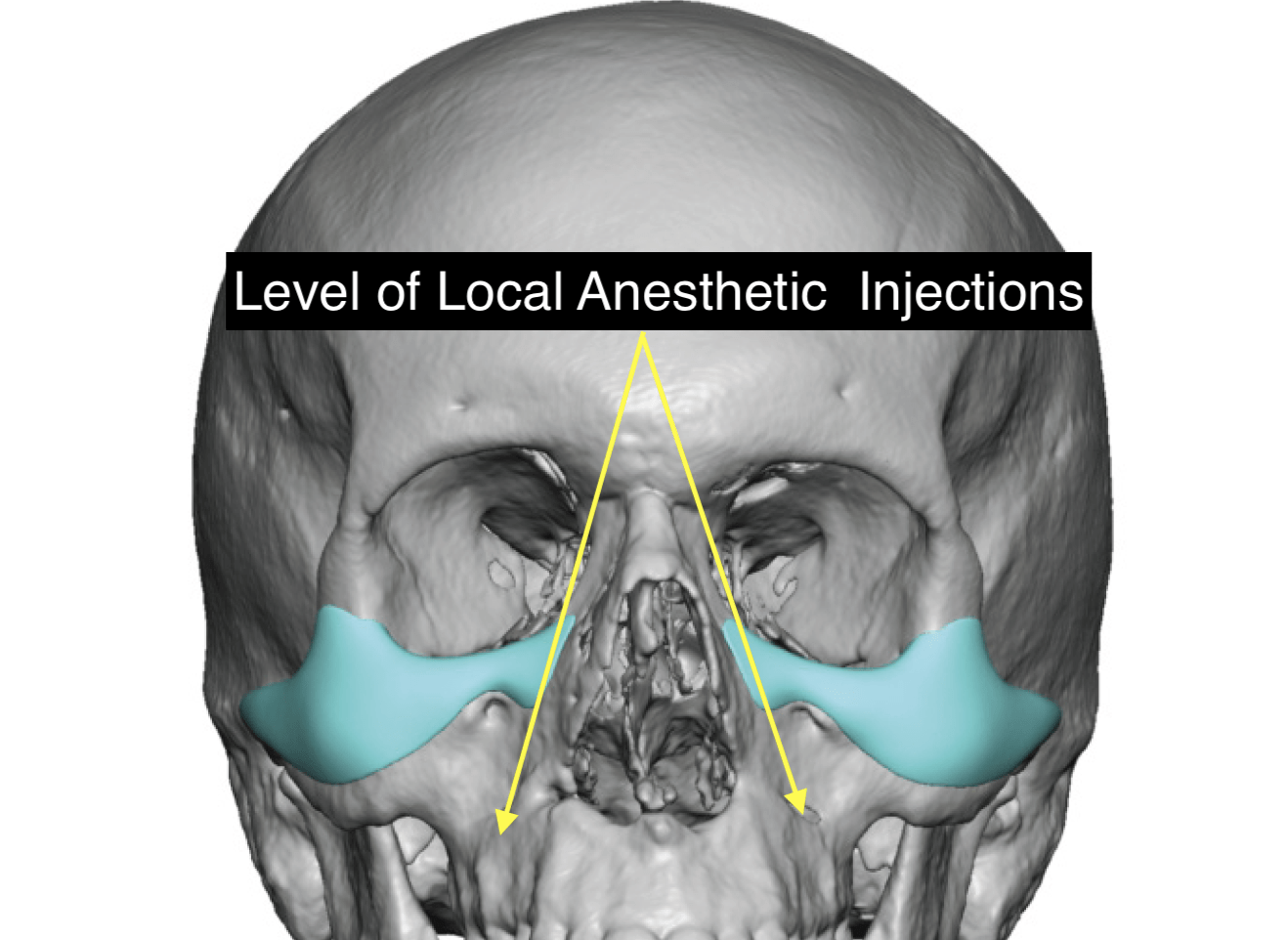What Is The Risk of Infecting Custom InfraorbitalMalar Implants from