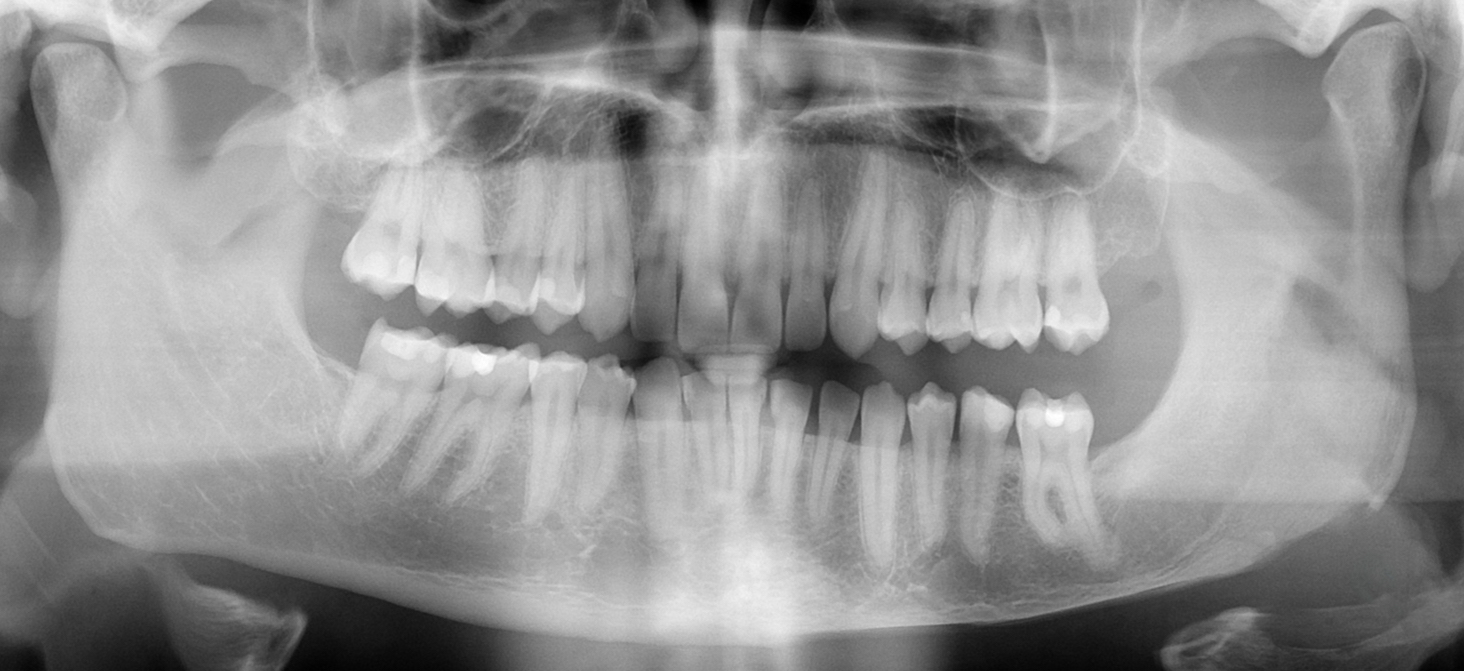 Jaw Augmentation Surgery Jawline Enhancement Surgeon Dr. Eppley