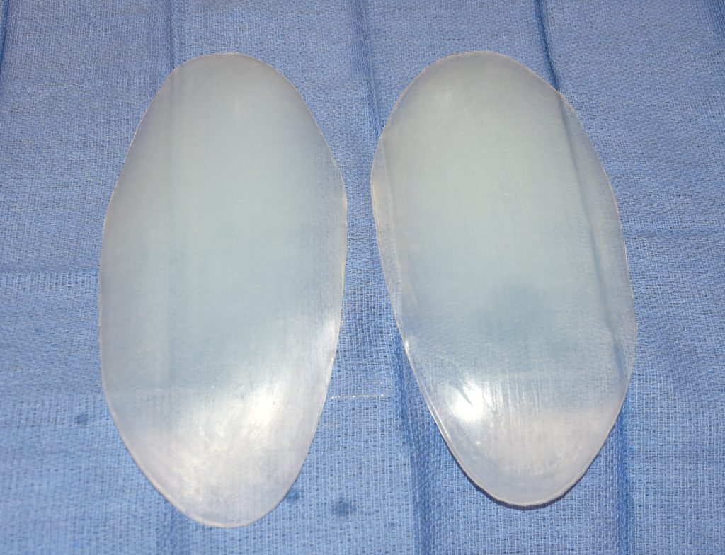 Body Implant Surgery Body Augmentation Surgeon Dr. Barry Eppley