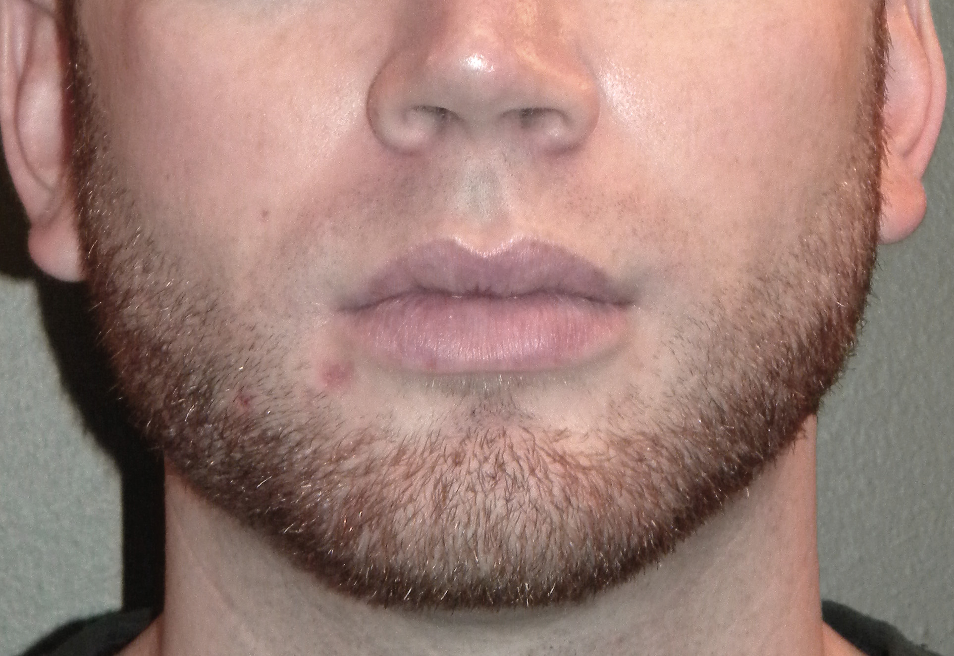 Jaw Augmentation Surgery Jawline Enhancement Surgeon Dr. Eppley