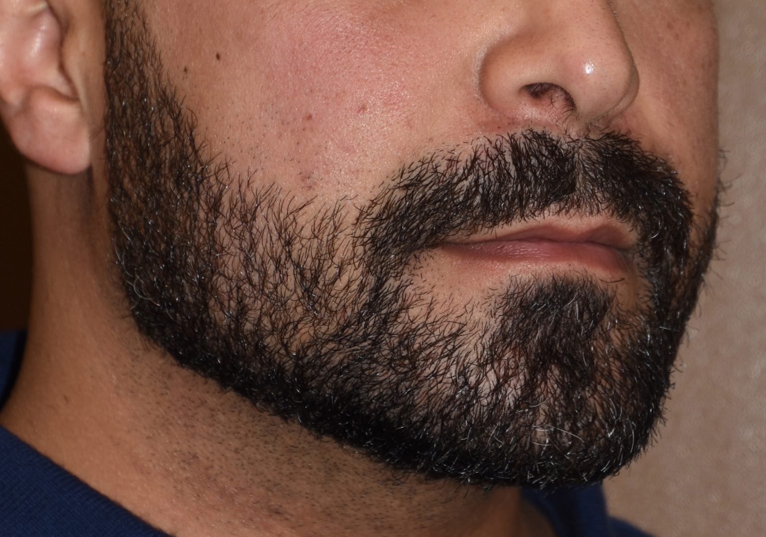 Jaw Augmentation Surgery Jawline Enhancement Surgeon Dr. Eppley