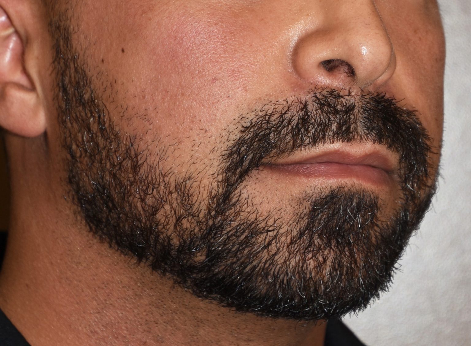 Jaw Augmentation Surgery Jawline Enhancement Surgeon Dr. Eppley