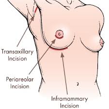 Breast Augmentation Surgery - Top Breast Implant Surgeon
